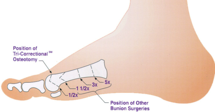 Placement of the Angulated Osteotomy