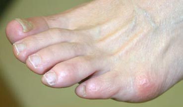 The fifth metatarsal bone starts to protrude outward.