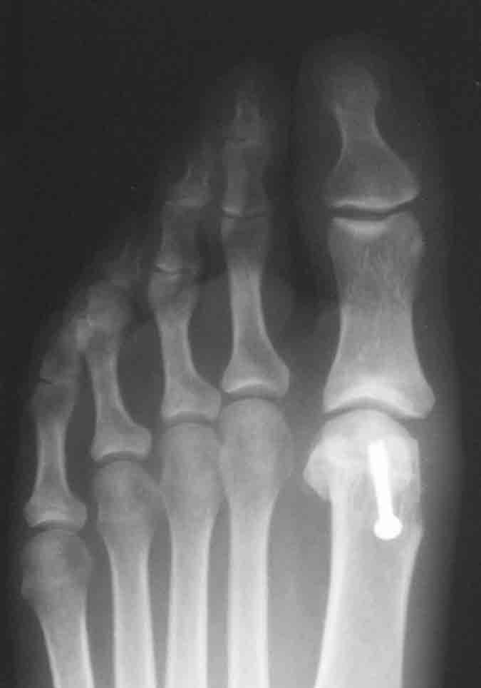 Post-operative x-ray with screw