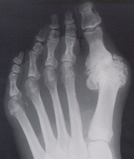 Bunion X-ray