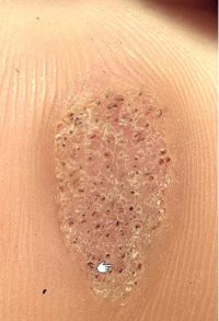 Plantar Warts - Joshua Kaye, DPM